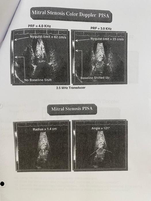 Mitral Stenosis Color Doppler PISA
\( 2.5 \mathrm{MHz} \) Transducer
Mitral Stenosis PISA