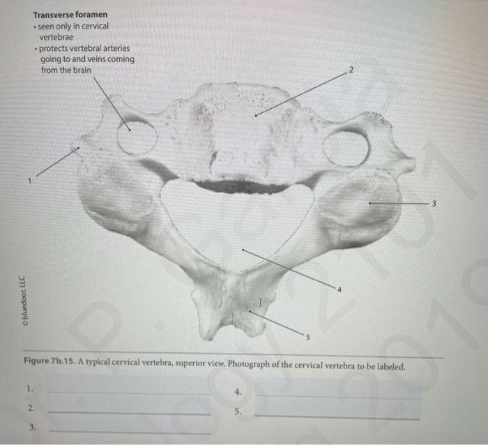 Solved Transverse foramen seen only in cervical vertebrae | Chegg.com