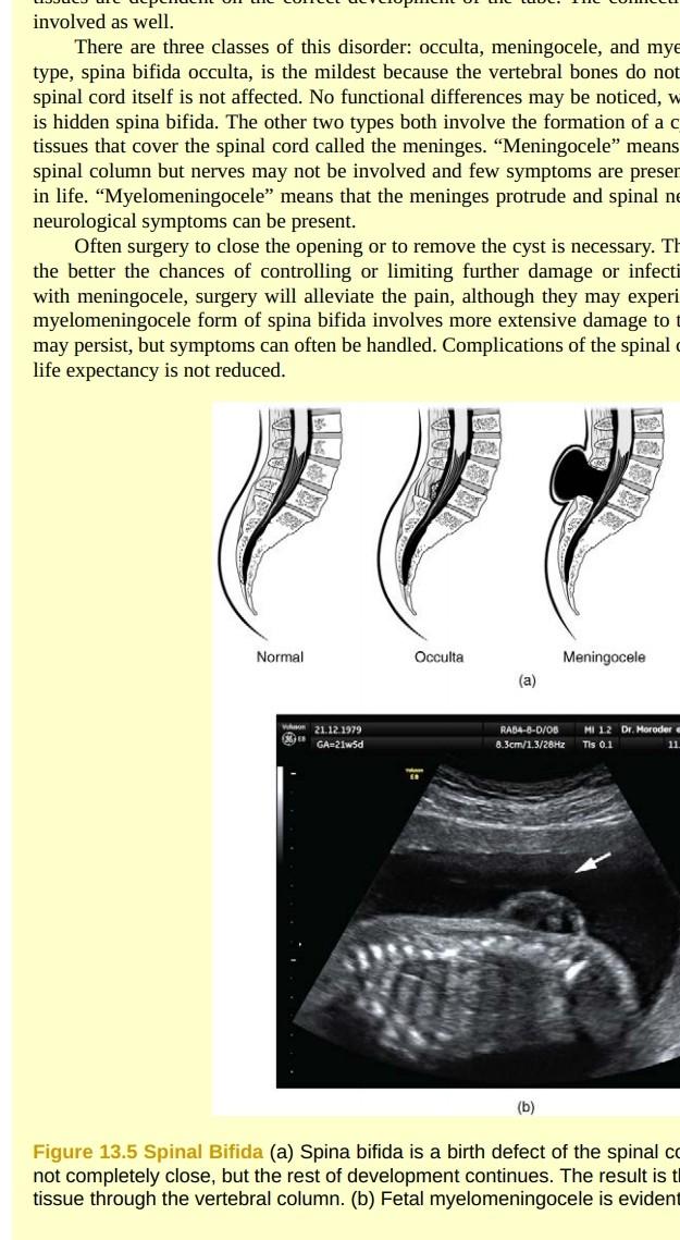 spina bifida life expectancy