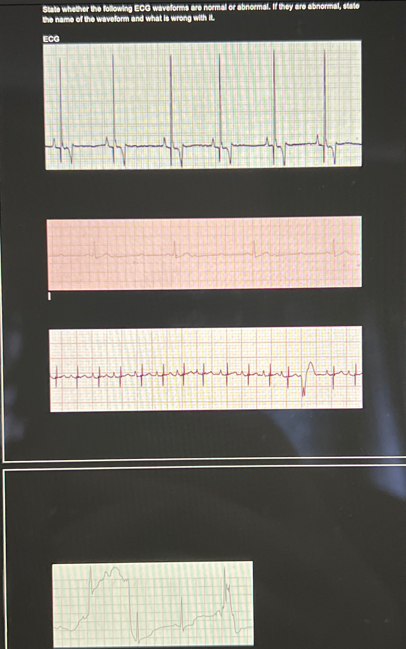 Solved Stato whether the following ECG wavetorms are normal | Chegg.com