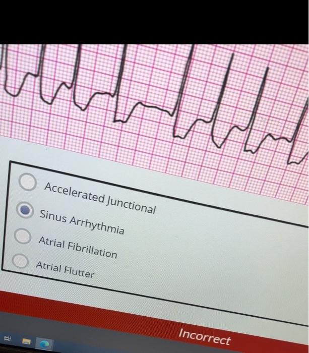 Sinus Arrhythmia Sinus Rhythm with PVC Sinus Rhythm | Chegg.com