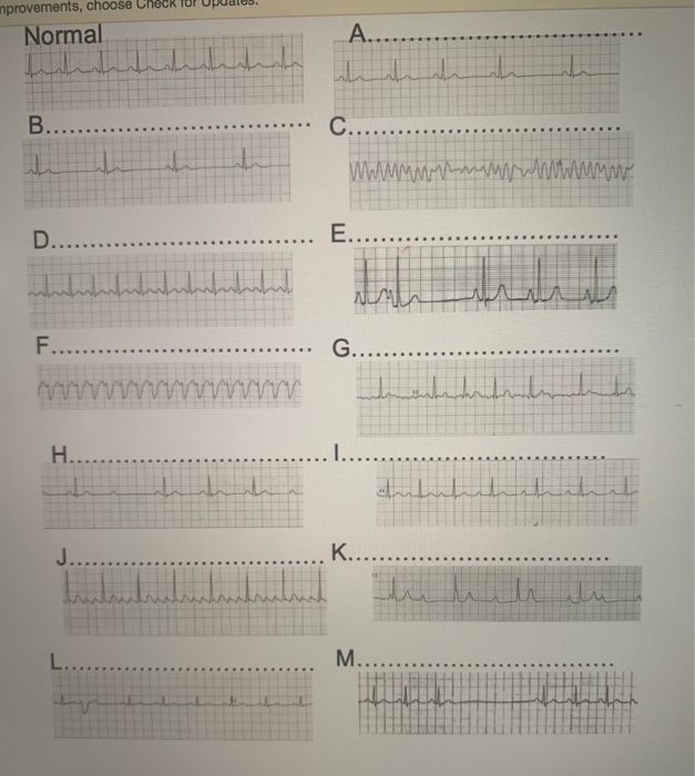Solved Match each ECG with its name:1.Sinus tachycardia2. | Chegg.com