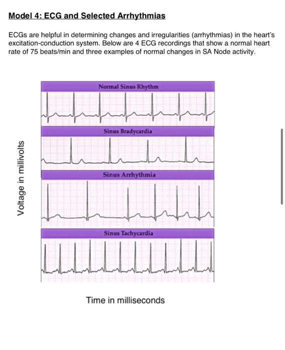 Solved Model 4 Ecg And Selected Arrhythmias Ecs Are Help Chegg Com