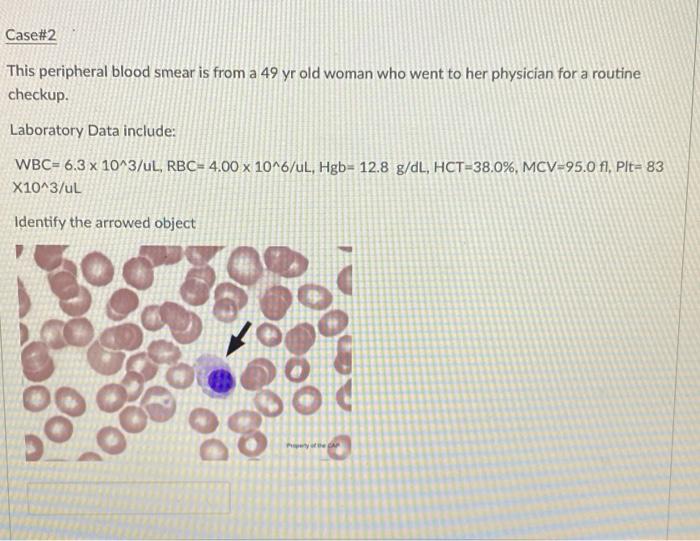 Solved Question 10 2 Pts Case#1 The Peripheral Blood Smear | Chegg.com