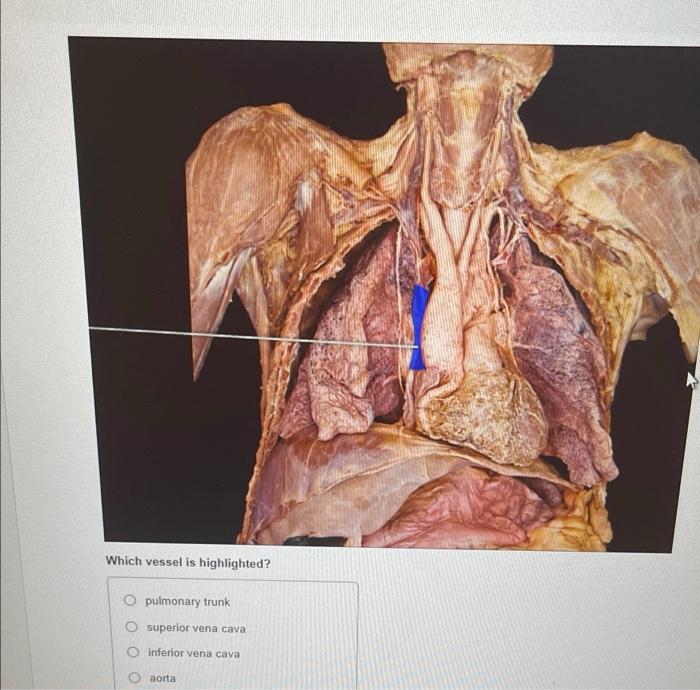 Which vessel is highlighted?
pulmonary trunk
O superior vena cava
inferior vena cava
aorta