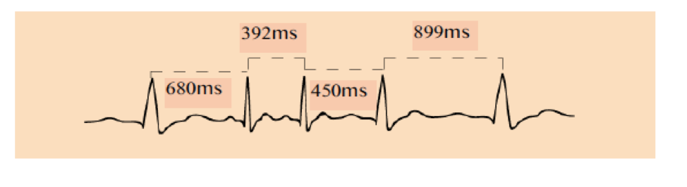 Solved |Calculate the average heart rate in bpm for the EKG | Chegg.com