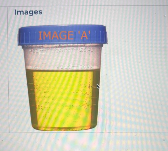 Solved 1. Explain the following CLIAwaived urine tests.