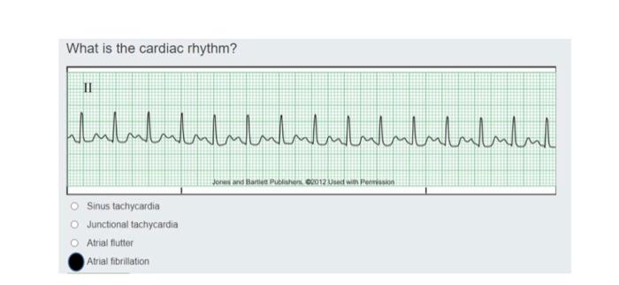 Solved What is the cardiac rhythm? | Chegg.com