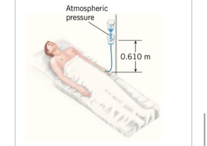 Solved The drawing shows an intravenous feeding tube With Chegg com