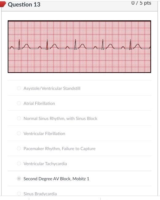 Solved Question 2 0/5 pts Asystole/Ventricular Standstill
