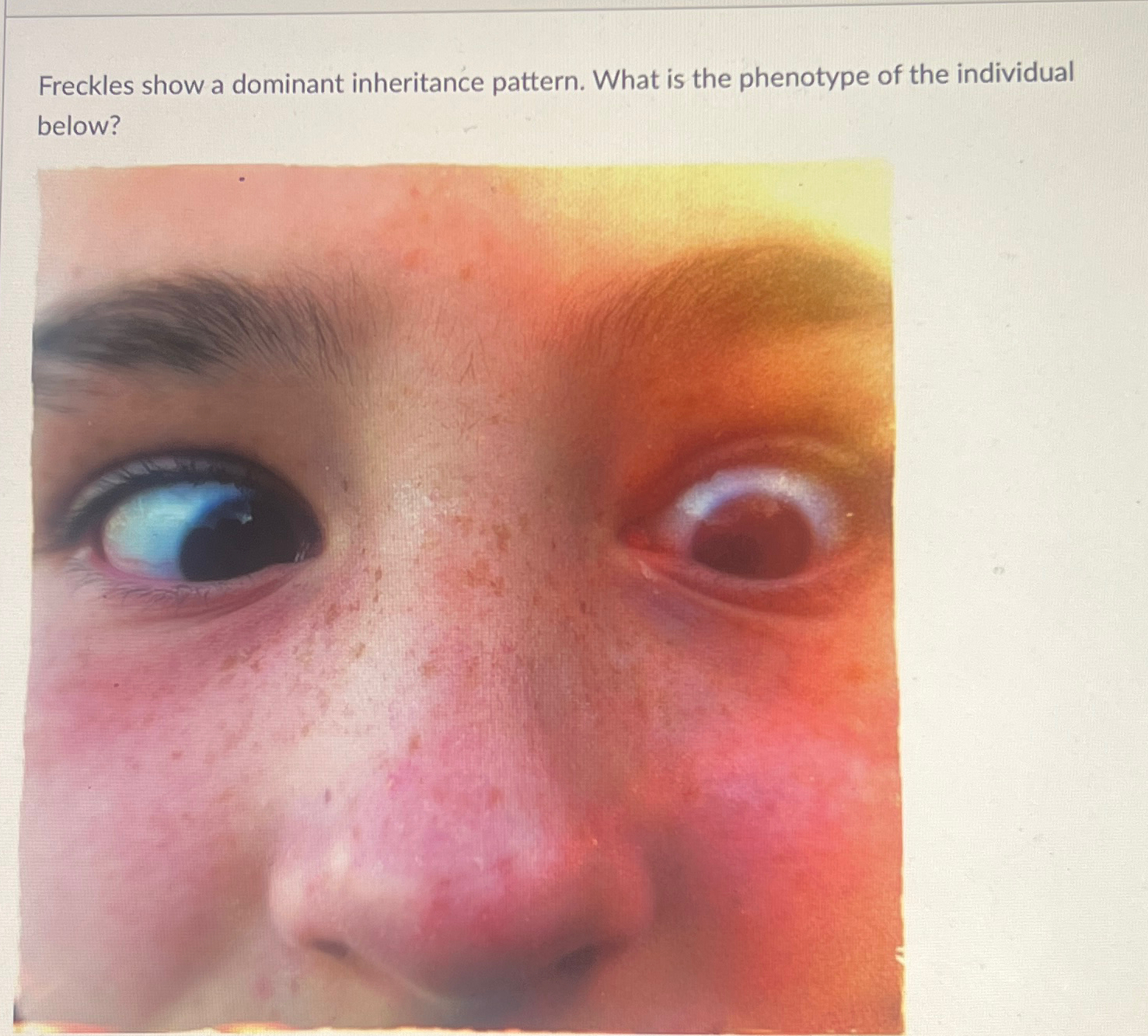 Solved Freckles show a dominant inheritance pattern. What is | Chegg.com