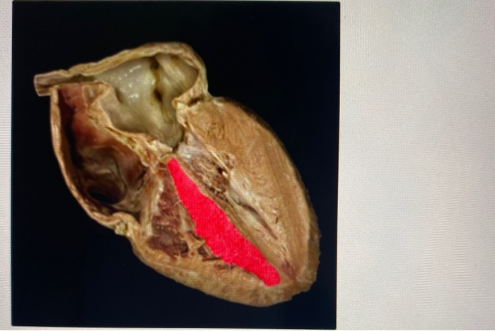 interventricular sulcus and septum