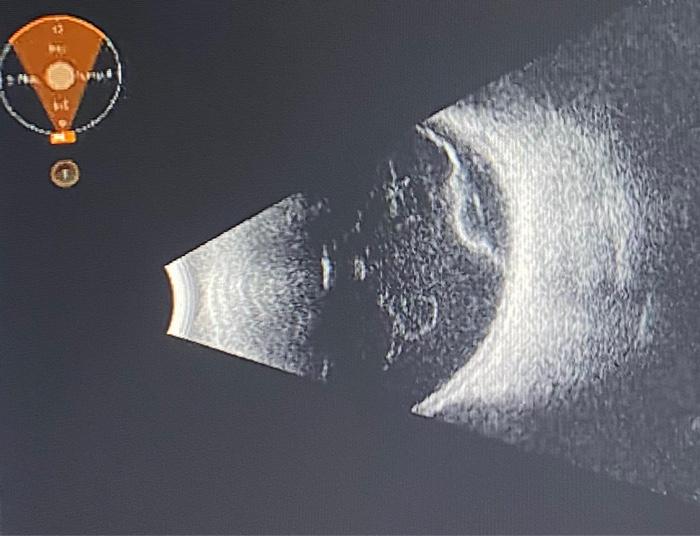Solved What does this patient's ultrasound of their eye