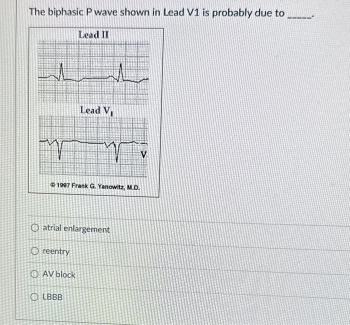 Solved The biphasic P wave shown in Lead V1 is probably due | Chegg.com