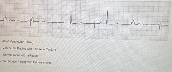 Solved 2nd Degree Heart Block Type II Sinus Rhythm with PJC | Chegg.com