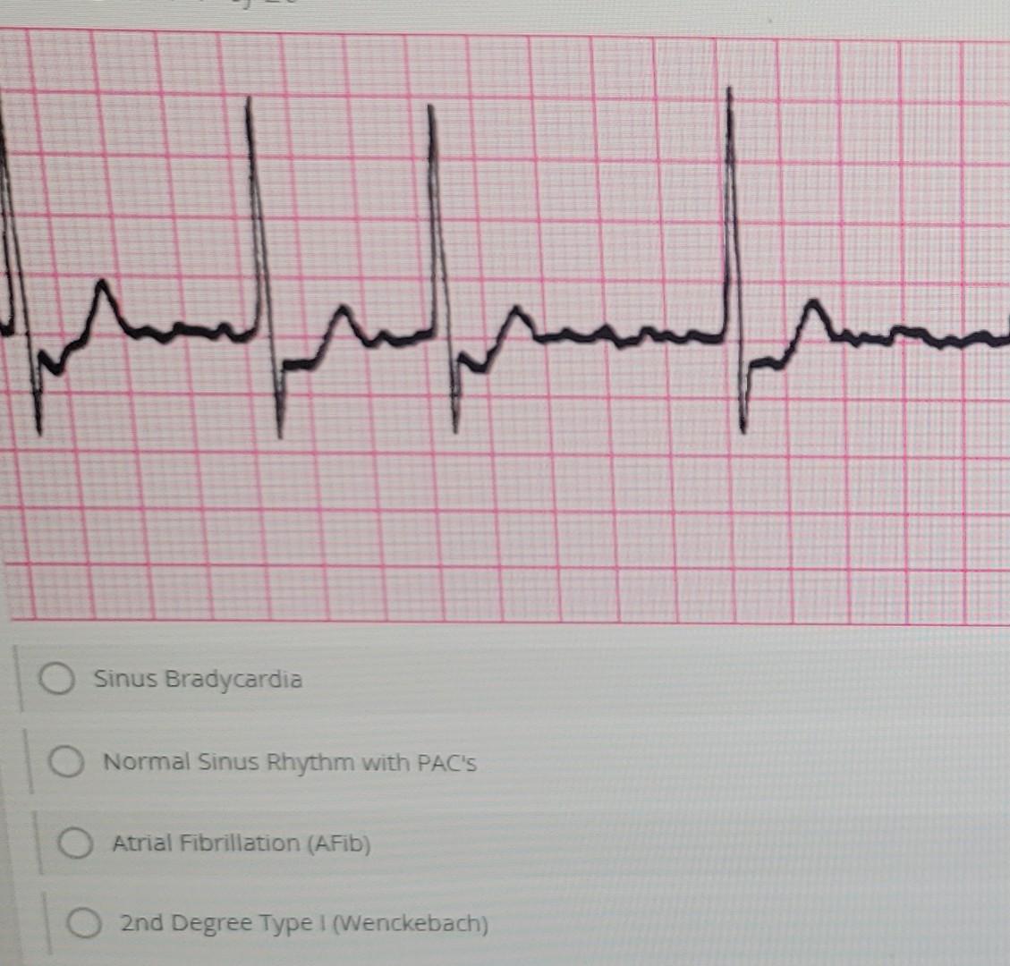 Solved Sinus Bradycardia Normal Sinus Rhythm with PAC'S | Chegg.com