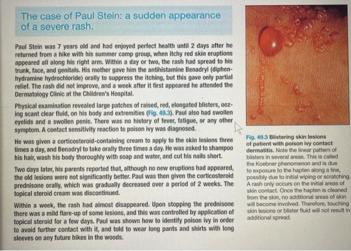 Solved Case 49 Poison Ivy 1. Paul had lesions not only on