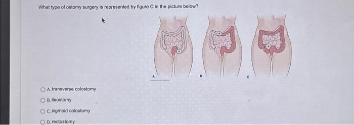 Solved What type of ostomy surgery is represented by figure | Chegg.com