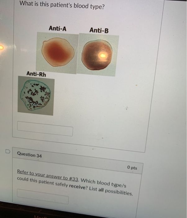 Solved What Is This Patient's Blood Type? Anti-A Anti-B | Chegg.com