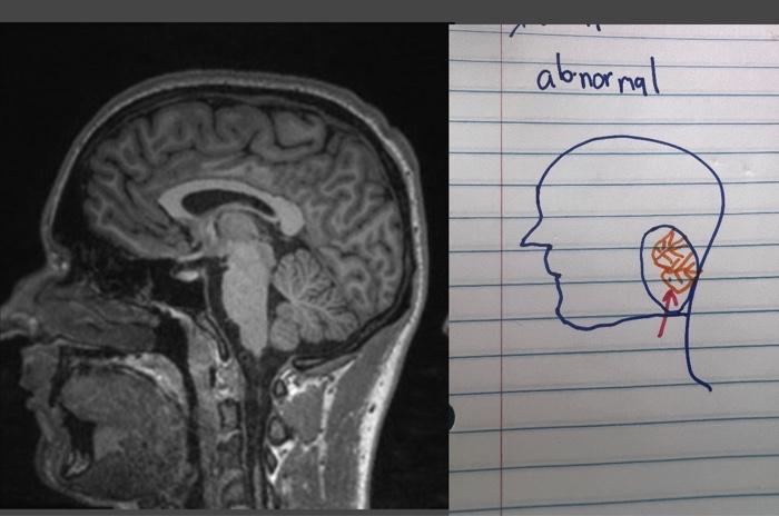 Solved this picture is normal vs abnormal MRI what | Chegg.com