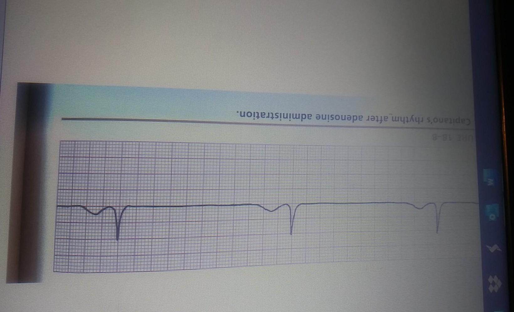 18-8 Capitanos rhythm after adenosine administration.