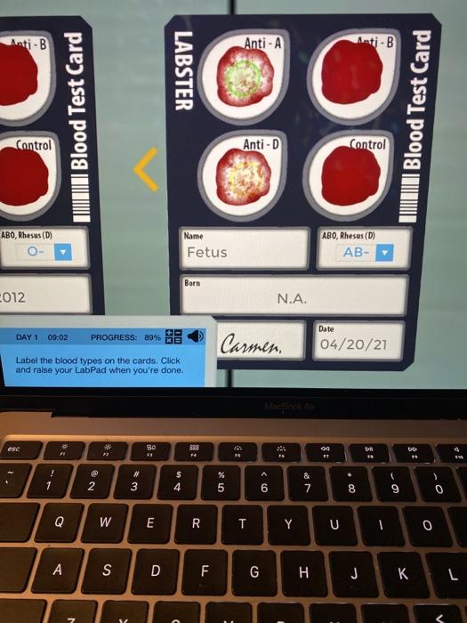 Solved AntiB AntiA AntiB LABSTER M Blood Test Card TONI