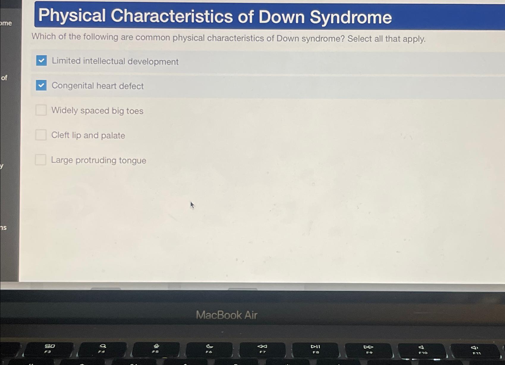Solved Physical Characteristics of Down SyndromeWhich of the | Chegg.com