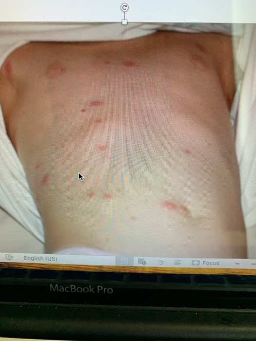 Solved 7 year old Angela with a complaint of a rash for | Chegg.com