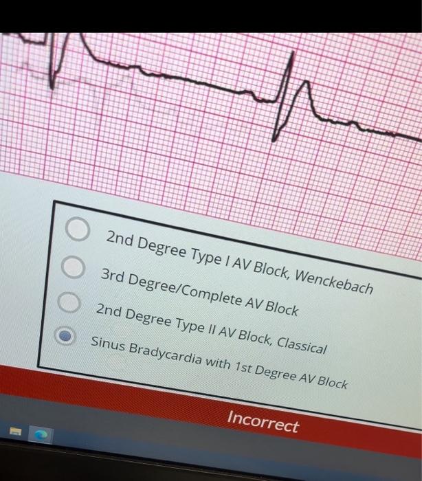 Solved 2nd Degree Type I AV Block, Wenckebach 3rd | Chegg.com