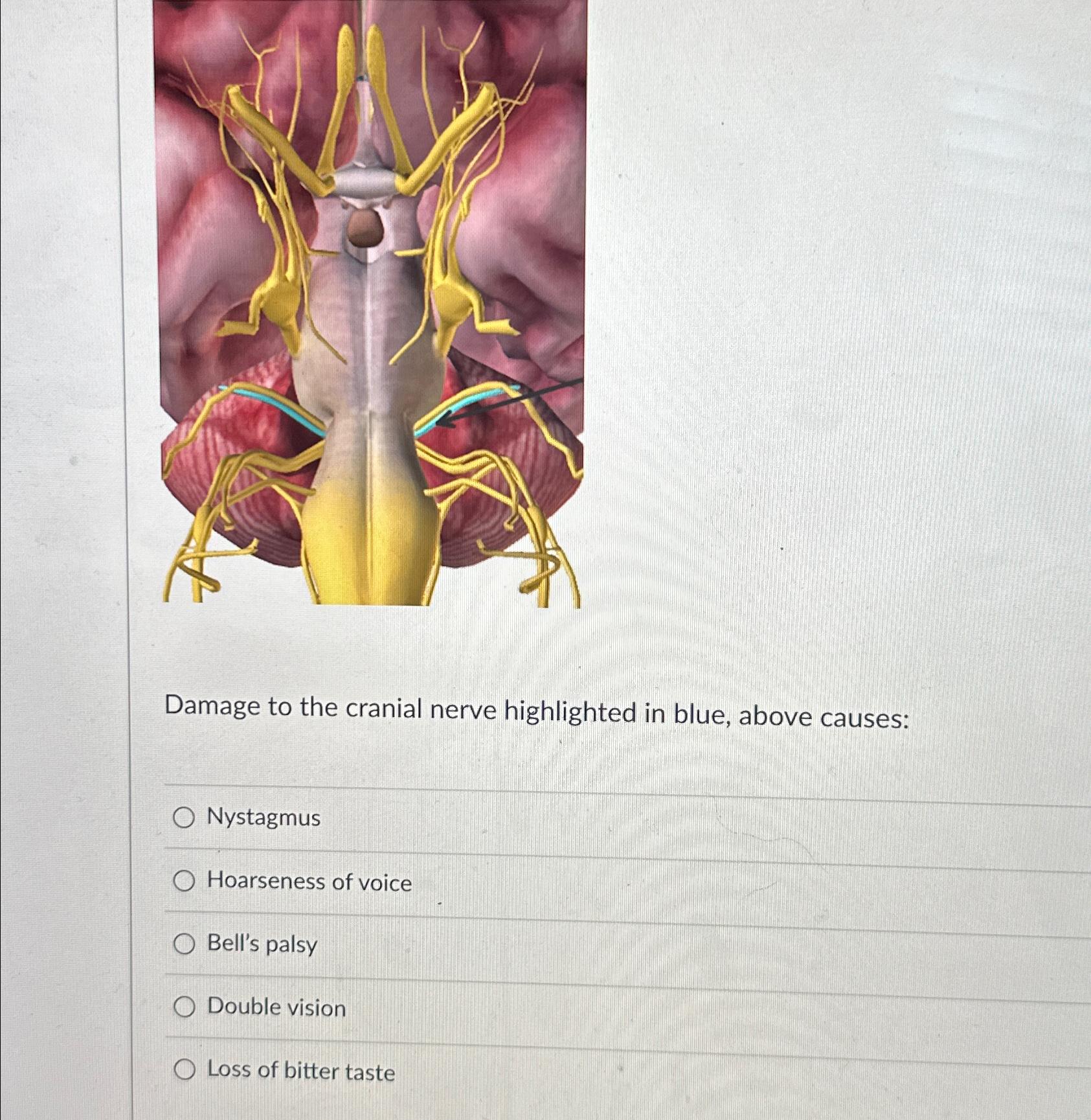 Solved Damage to the cranial nerve highlighted in blue, | Chegg.com