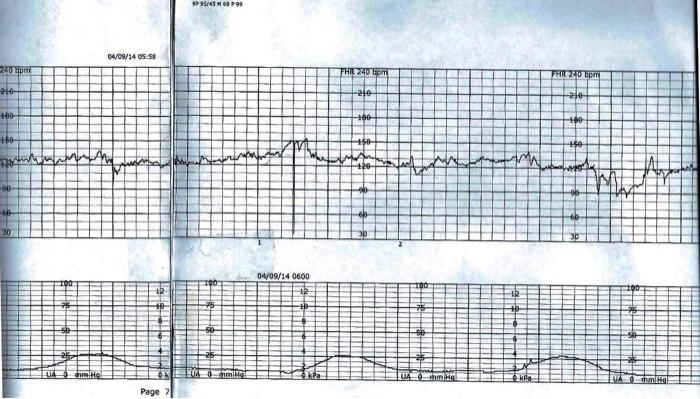 P95/459 04/09/14 05:58 40 pm FHR 240 lip FHR 240 bpm 210- 210 210 100 150 pando 16 20 04/09/14 0600 na Ho CA DRUL im Me crimi