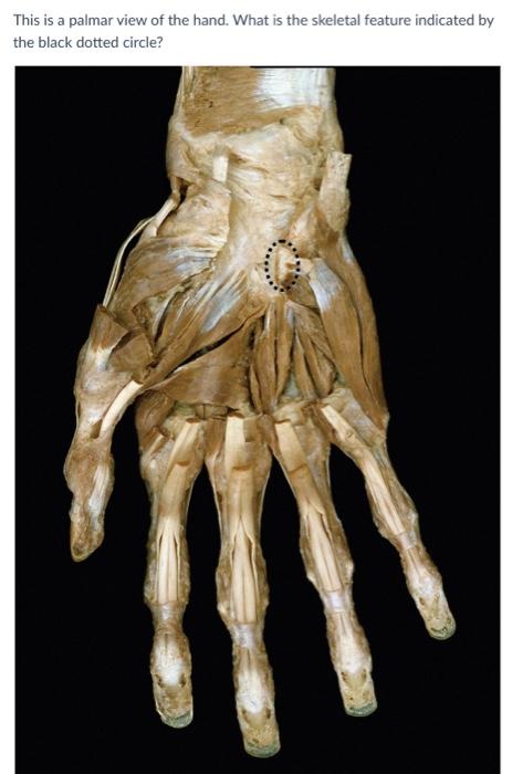 This is a palmar view of the hand. What is the skeletal feature indicated by the black dotted circle?