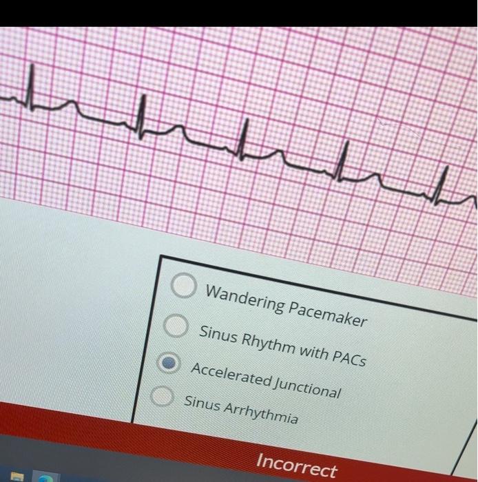 Solved Junctional Tachycardia Supraventricular Tachycardia | Chegg.com