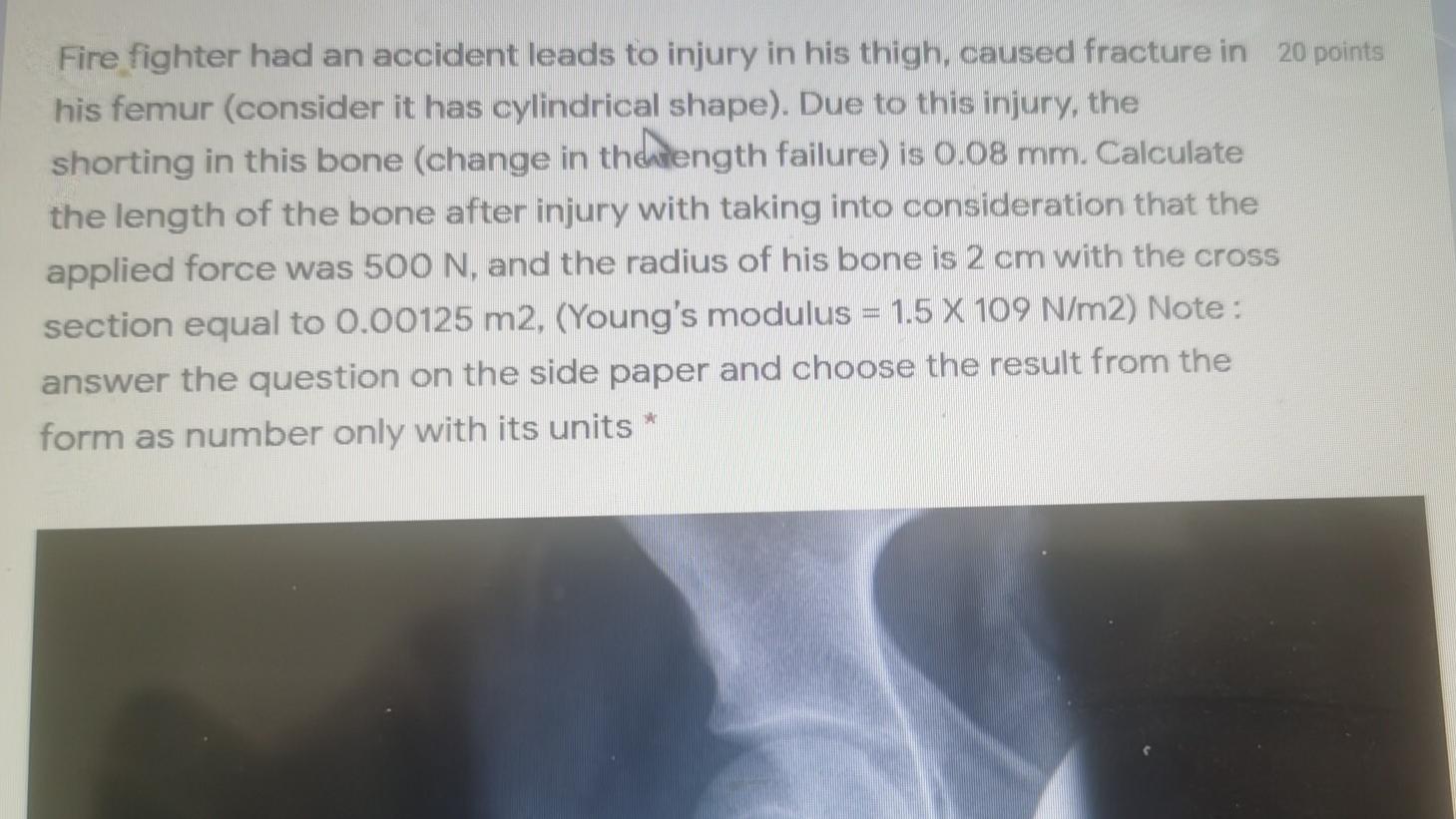 Fire fighter had an accident leads to injury in his thigh, caused fracture in 20 points his femur (consider it has cylindrica
