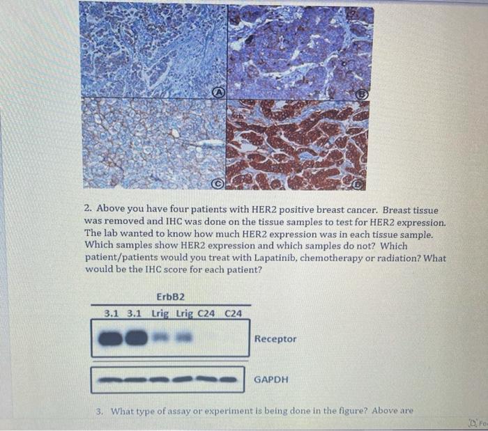 2. Above you have four patients with HER2 positive breast cancer. Breast tissue was removed and IHC was done on the tissue sa