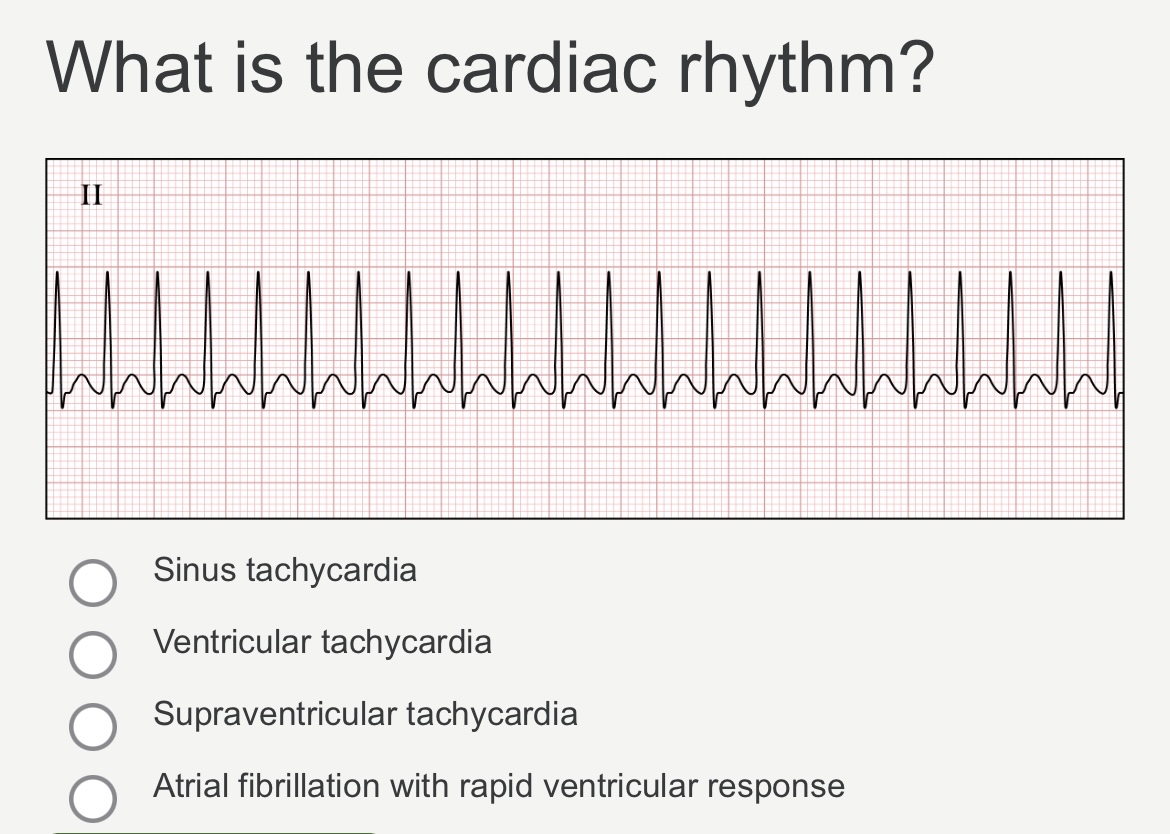 Solved What is the cardiac rhythm shown in the EKG strip | Chegg.com