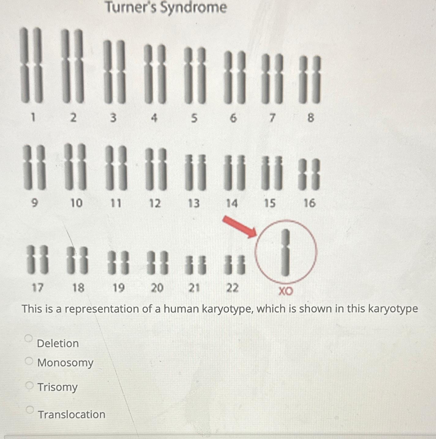 Solved Turner's SyndromeThis is a representation of a human | Chegg.com