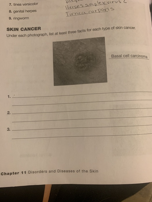 Solved 7. tinea versicolor 8. genital herpes 9. ringworm