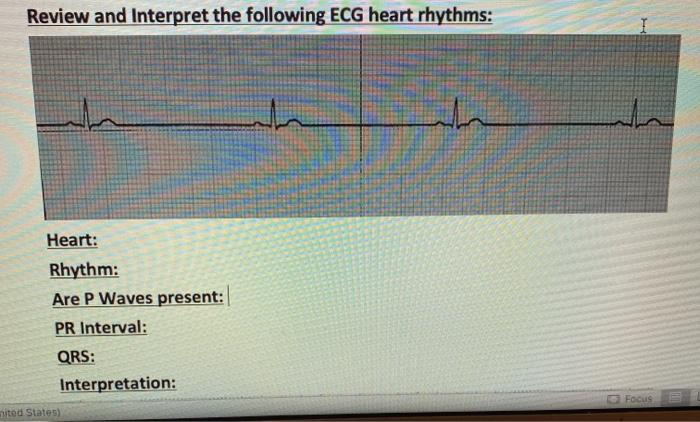 Review and Interpret the following ECG heart rhythms: the Heart: Rhythm: Are P Waves present: PR Interval: QRS: Interpretatio