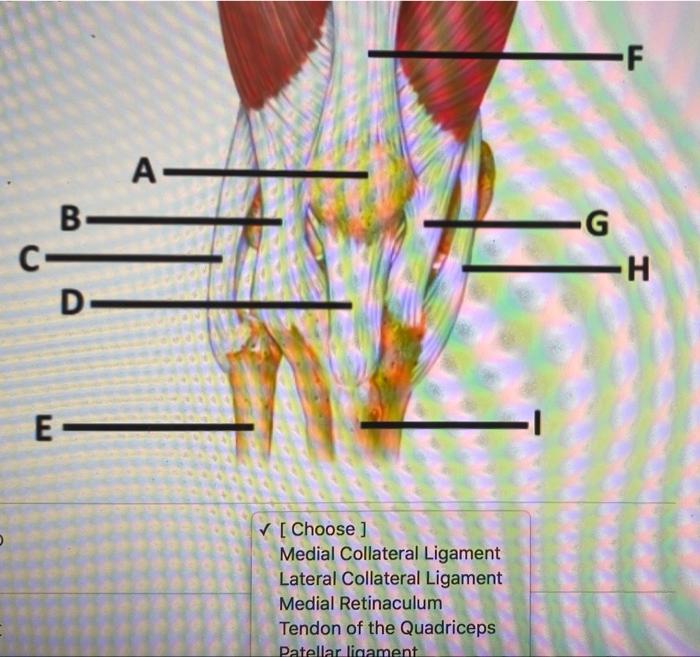 Solved [ Choose ] Medial Collateral Ligament Lateral | Chegg.com