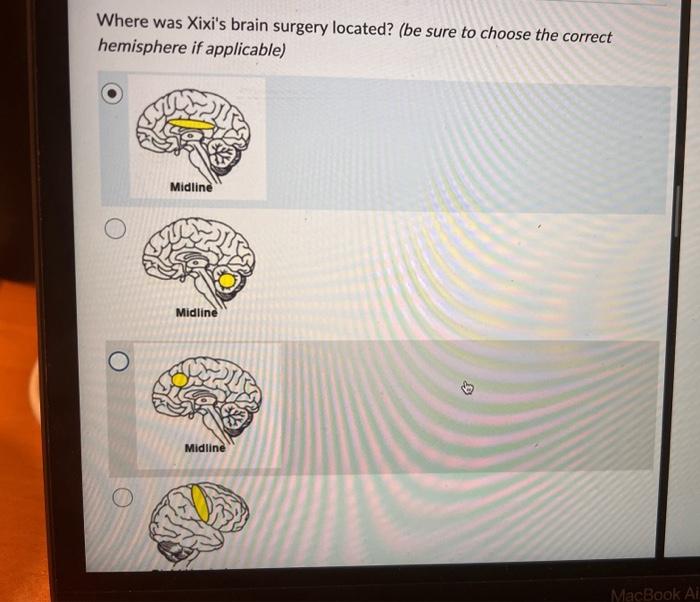 Solved Xixi had a rare and severe form of epilepsy, so | Chegg.com