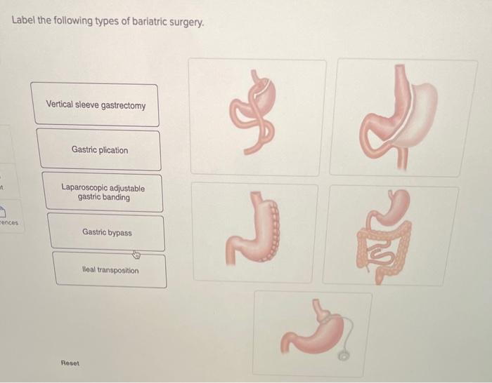 Solved Label the following types of bariatric surgery. | Chegg.com