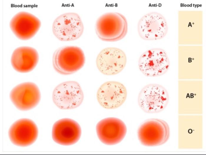 Solved Blood sample Anti-A Anti-B Anti-D Blood type A+ B+ | Chegg.com