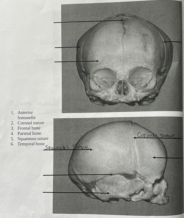 Solved 1. Anterior fontanelle 2. Coronal sut। 3. Frontal bon