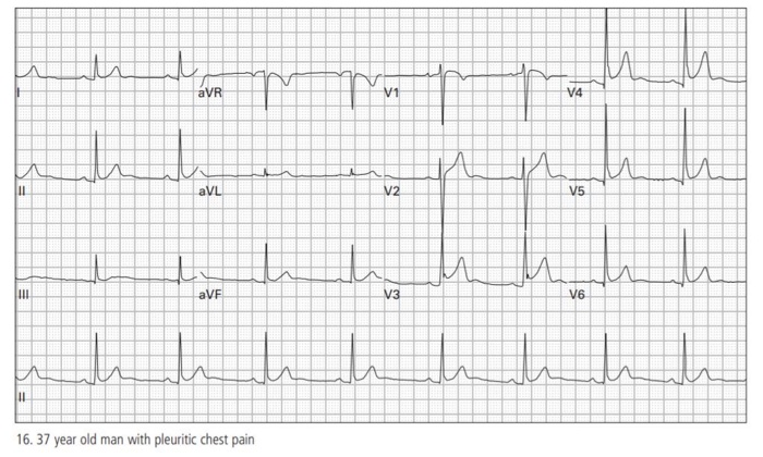 Solved uu i thu 2 aVR V1 V4 ПИЛ u aVL V2 V5 u 111 aVF V3 V6 | Chegg.com