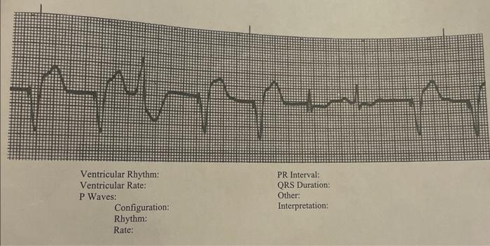 Solved PR Interval: QRS Duration: Other: Interpretation: | Chegg.com