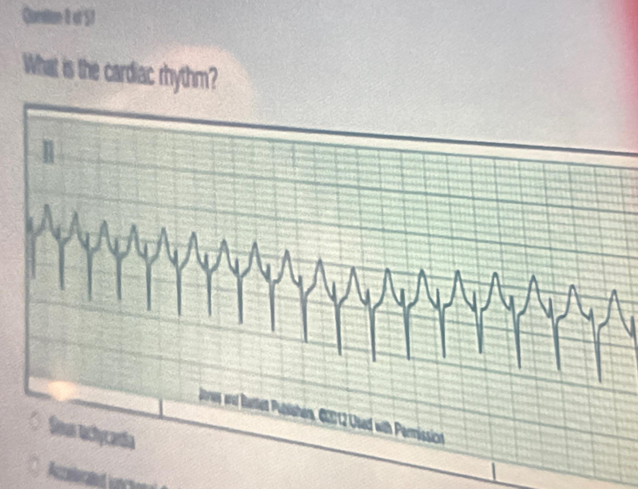 What is the cardiac rhythM? ﻿Sinus tachy ,