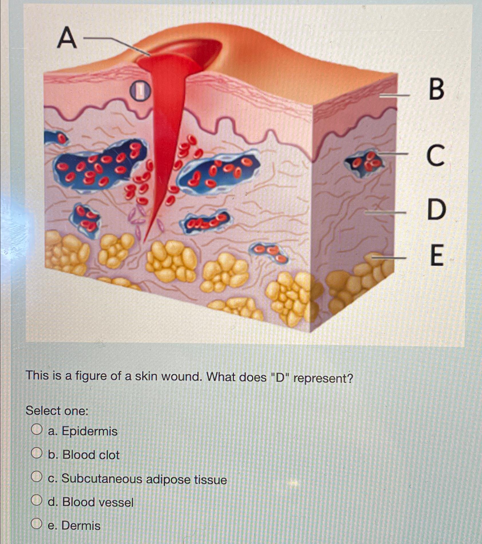 This is a figure of a skin wound. What does 