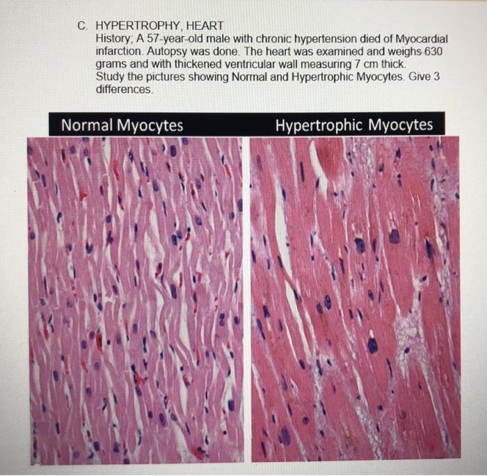 C. HYPERTROPHY, HEART History, A 57-year-old male with chronic hypertension died of Myocardial infarction. Autopsy was done.