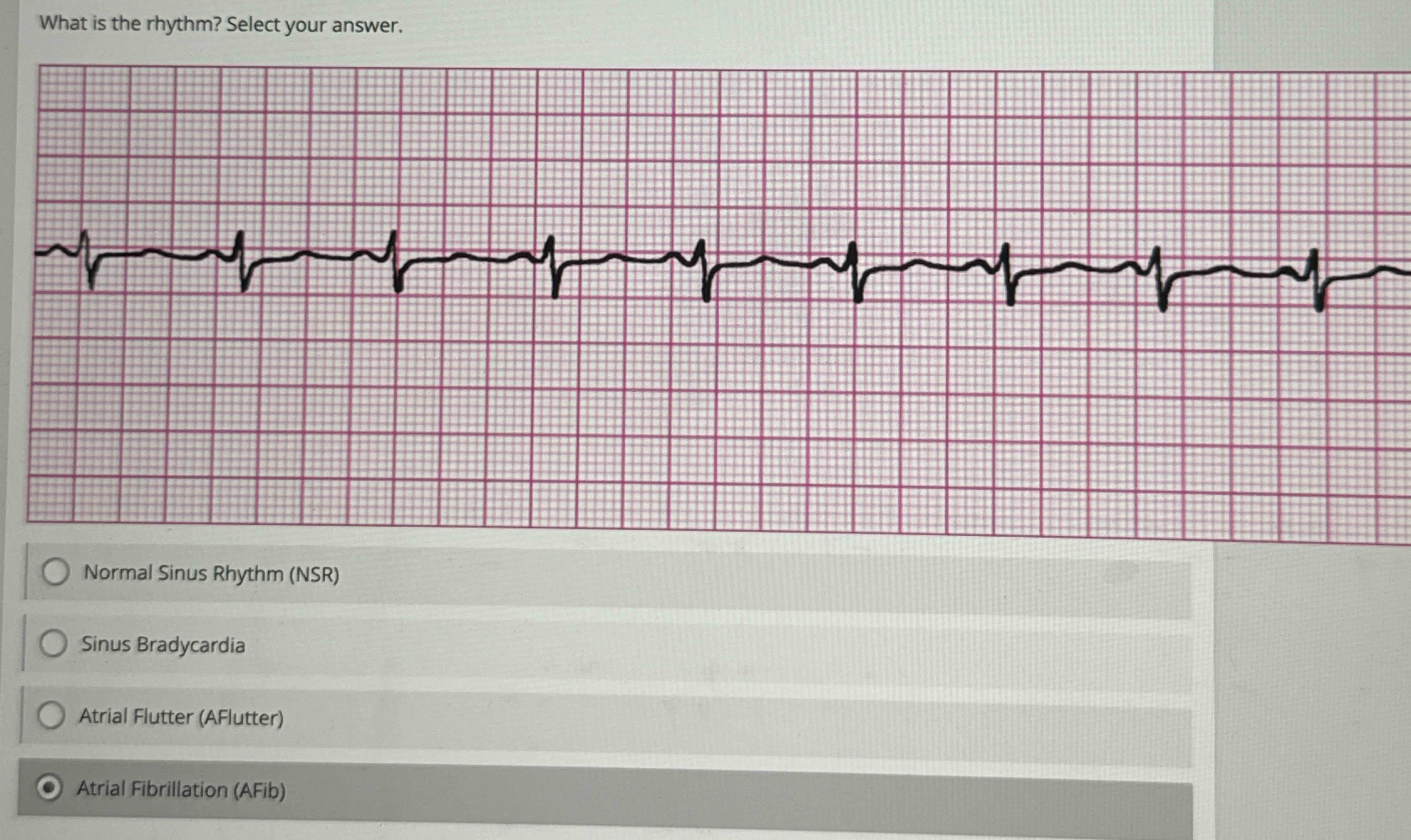 Solved What is the rhythm? Select your answer. Normal Sinus | Chegg.com